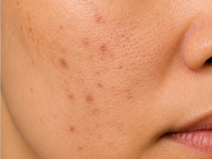 Acne Marks