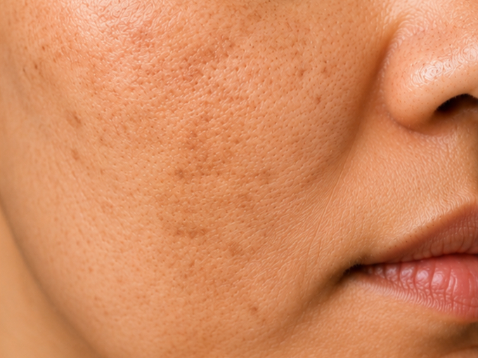 Uneven & Dull Skin